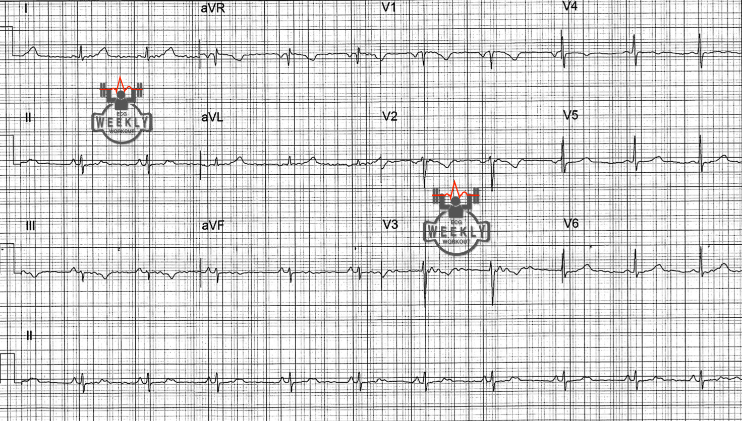 Presenting ECG — STAT ECG Diagnoses: epsilon waves in patient with syncope