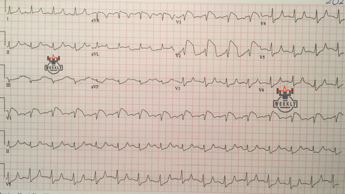 Presenting ECG — Differential Diagnoses: hyperkalemia as a cause of ST segment elevation mimicking STEMI