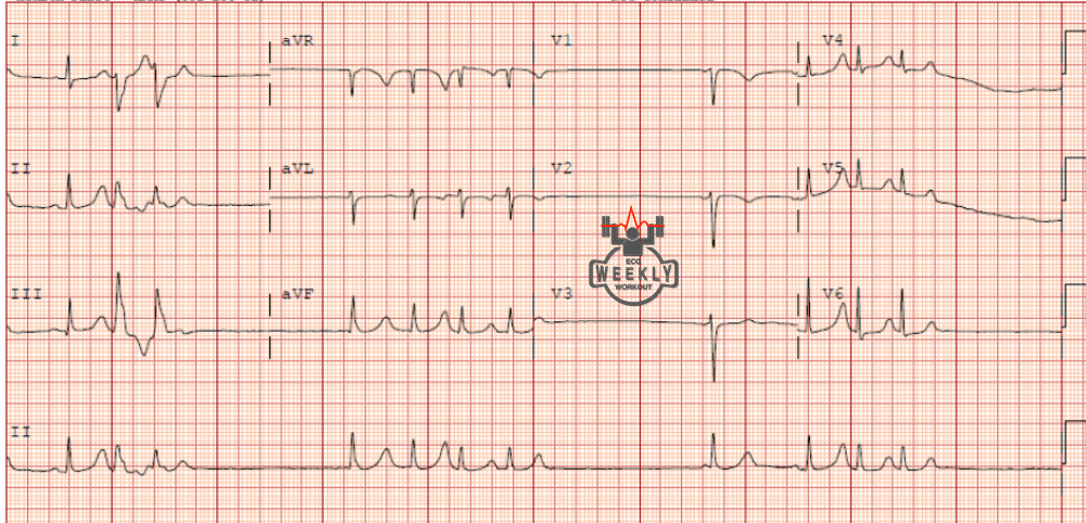 Presenting ECG — Literature Review: can the ECG risk stratify for short-term adverse events in severe hyperkalemia?
