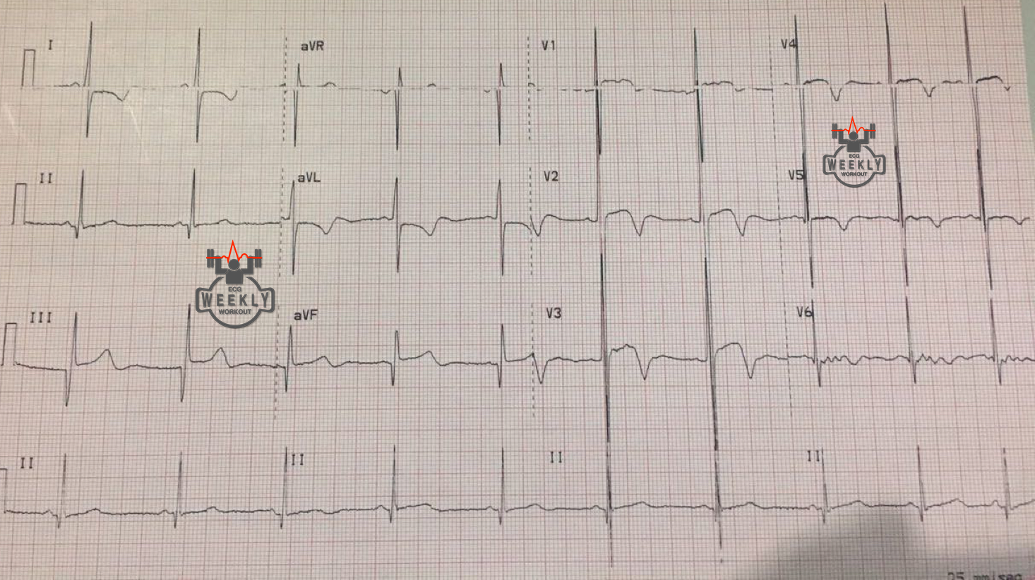 Presenting ECG — ECG Basics and Fundamentals: Hypertrophic Cardiomyopathy