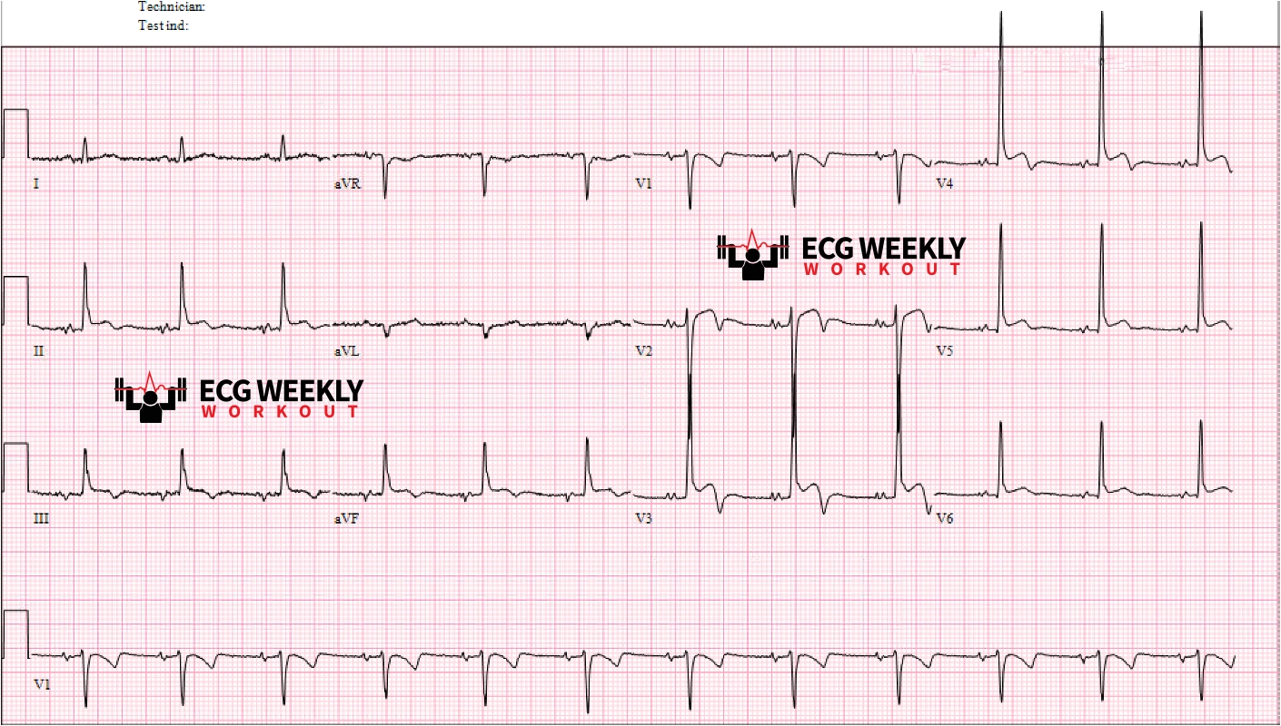 Presenting ECG — Do these biphasic T waves and ST segment abnormalities suggest acute coronary occlusion MI?