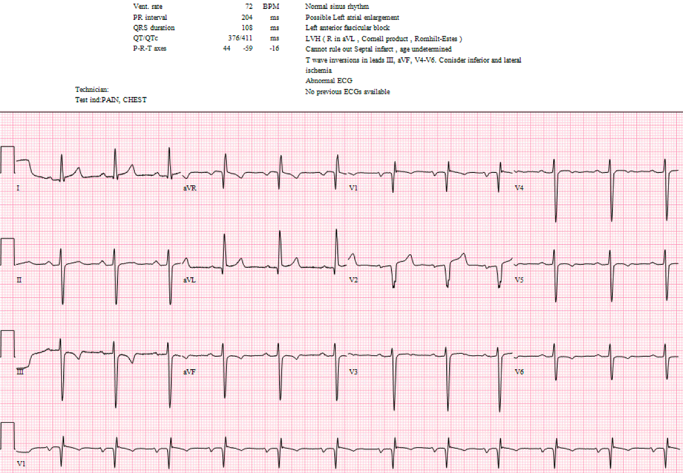Presenting ECG — Literature Review: Precordial lead placement and its impact on ECG interpretation and clinical care