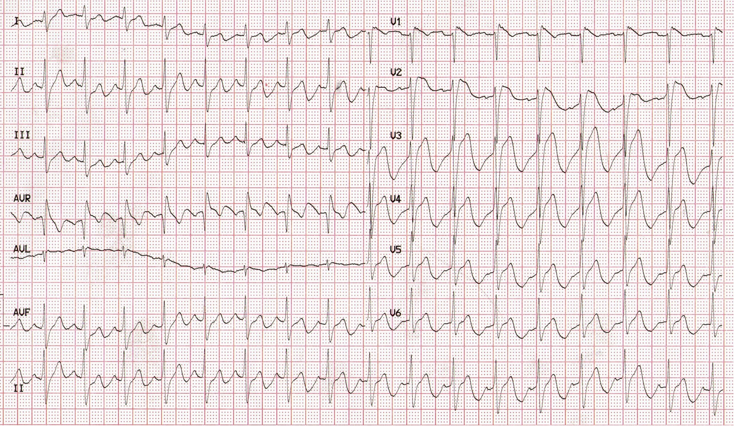 Presenting ECG — Literature Review: ST segment elevation after syncope and cardiac arrest