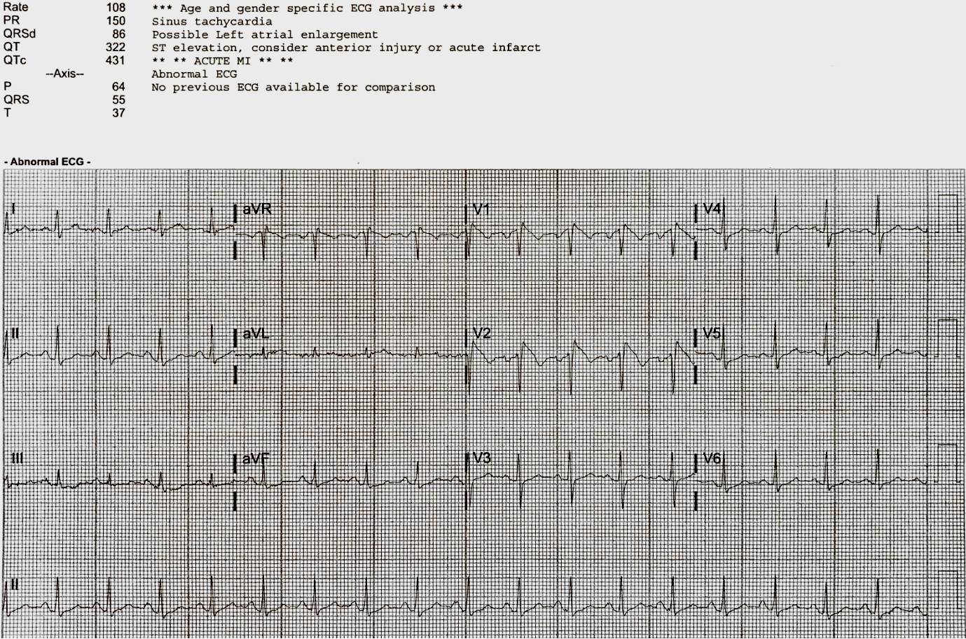 Presenting ECG — Literature Review: Fever and ST segment elevation after syncope