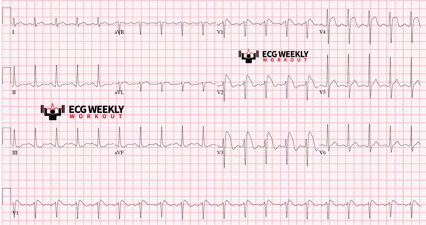 Presenting ECG — Literature Review: Brugada Syndrome