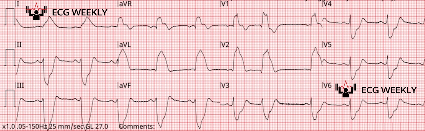 Presenting ECG — Literature Review: Shark Fin or "Triangular" ST segment morphology