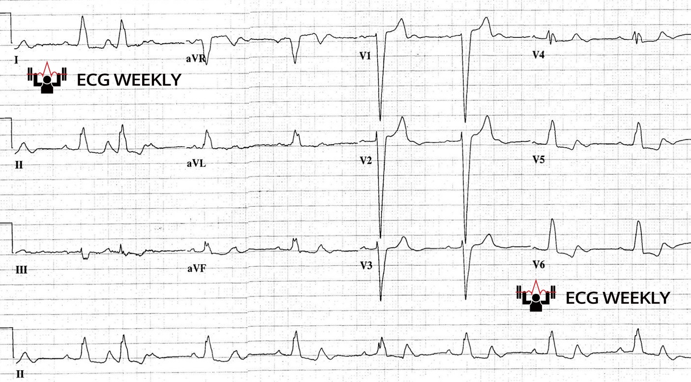 Presenting ECG — Sloof Lirpa Sign