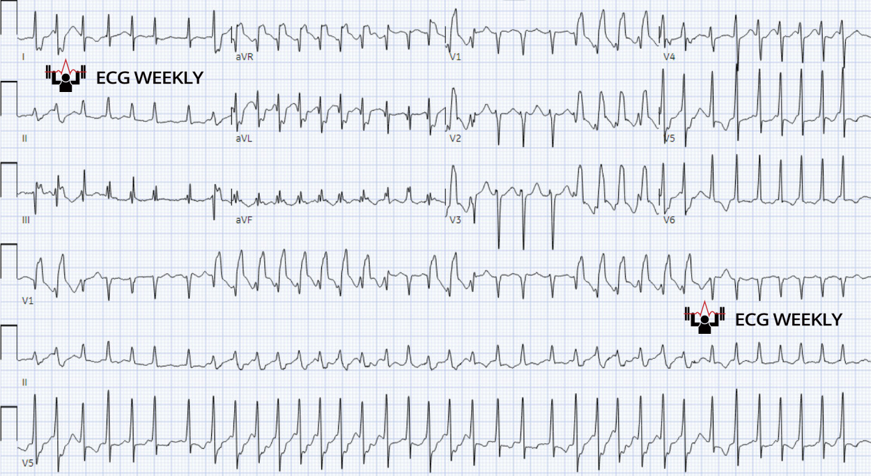 Presenting ECG — Runs of ventricular tachycardia vs. another phenomenon