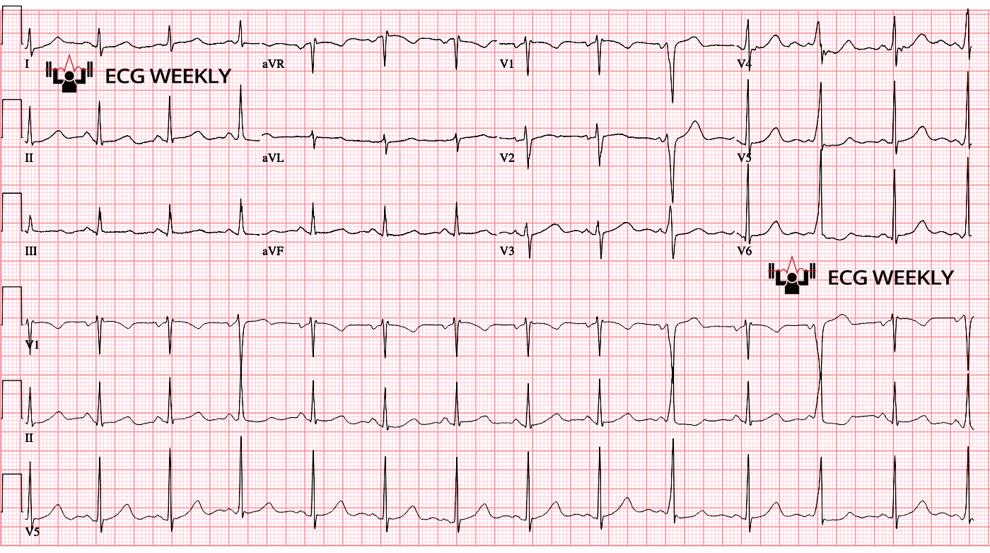 Presenting ECG — Post cardioversion ECG of SVT in patient with palpitations and near syncope