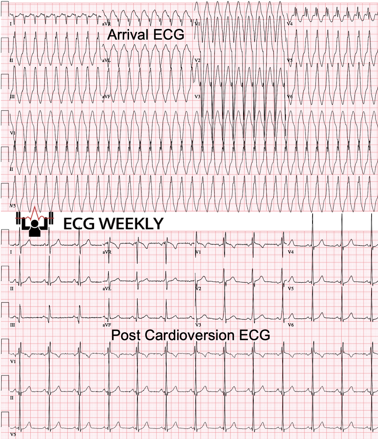 Presenting ECG — Wolff-Parkinson-White (WPW) Syndrome with Supraventricular Tachycardia (SVT)