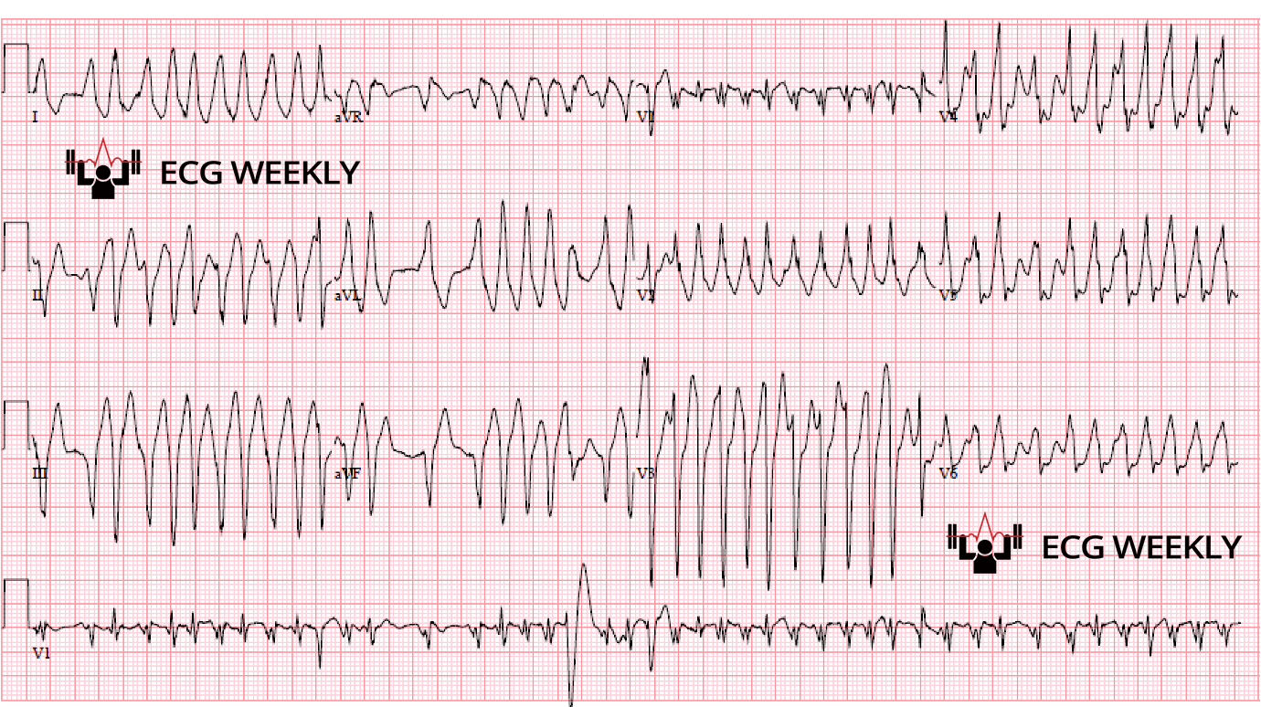 Presenting ECG — Wolff-Parkinson-White (WPW) Syndrome with Atrial Fibrillation (Afib)
