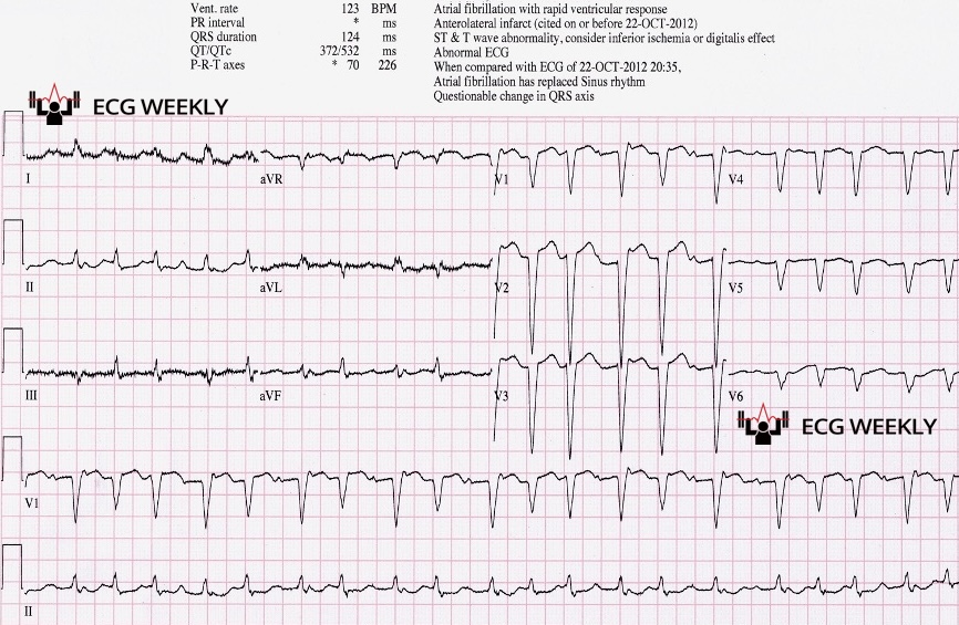 Presenting ECG — How to avoid misdiagnosis of irregular rhythms