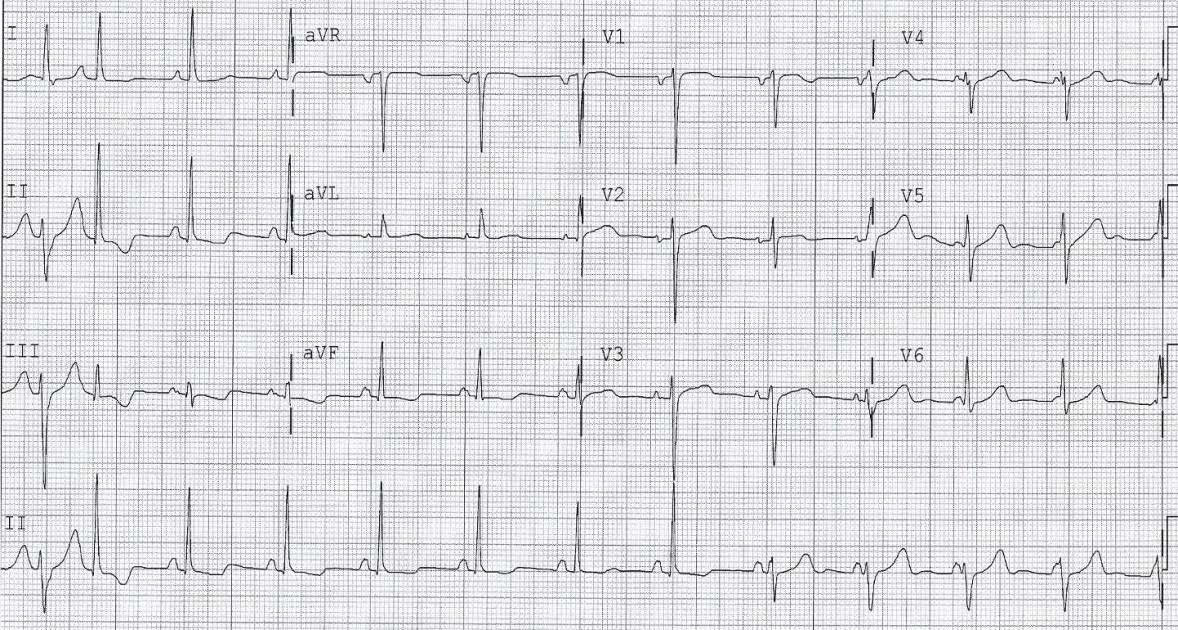 handout 12th annual UMEM ECG comp handout 12th annual UMEM ECG comp