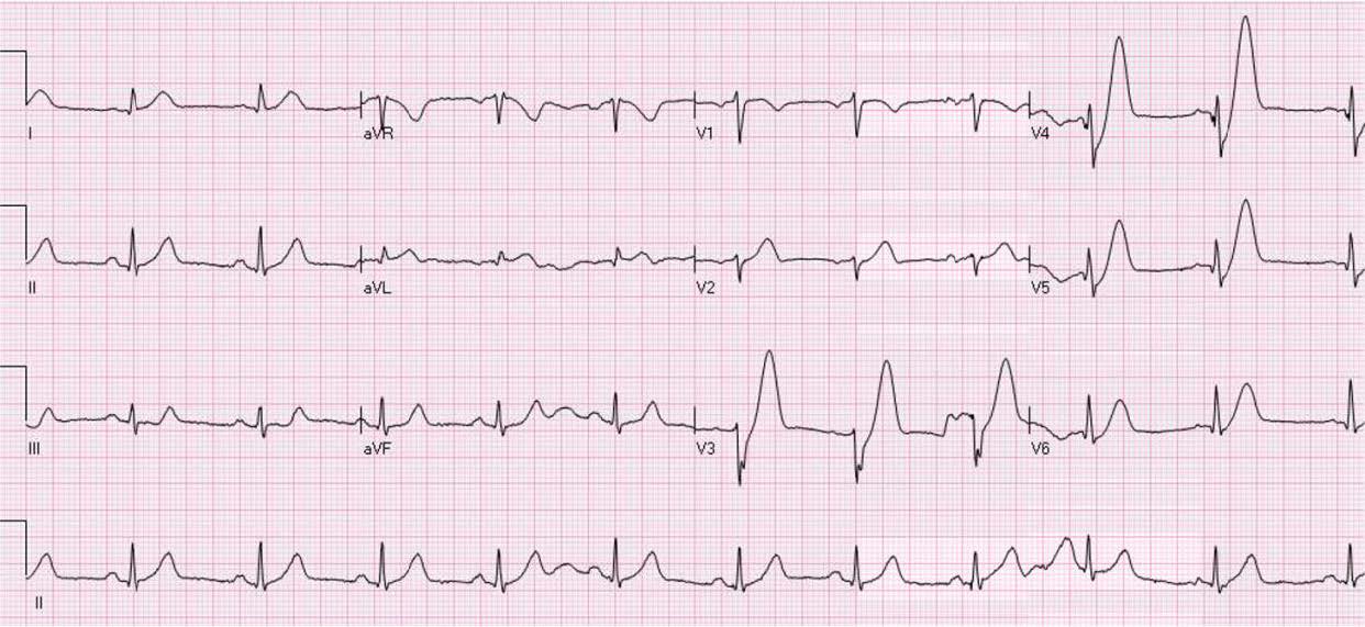handout 12th annual UMEM ECG comp handout 12th annual UMEM ECG comp
