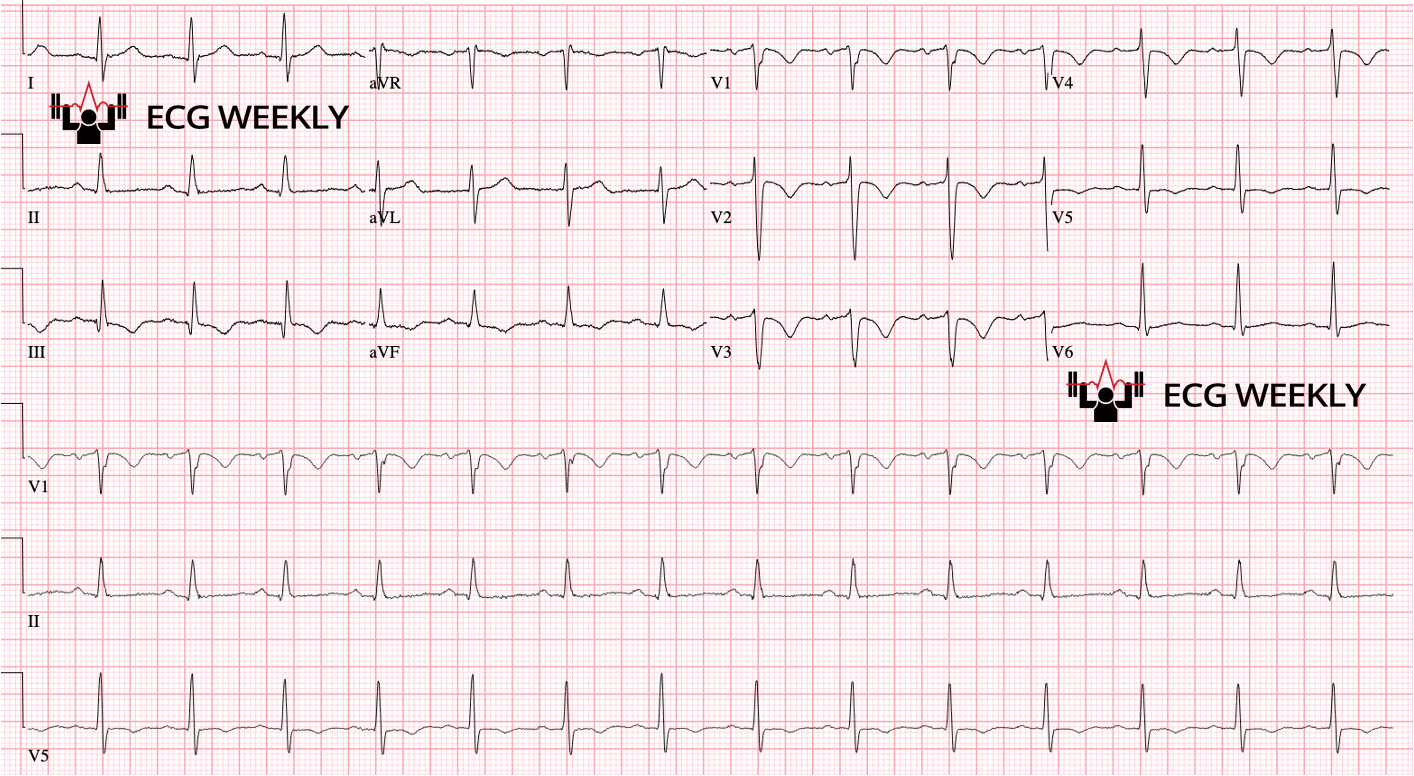 Presenting ECG — Recent UMMC Cases