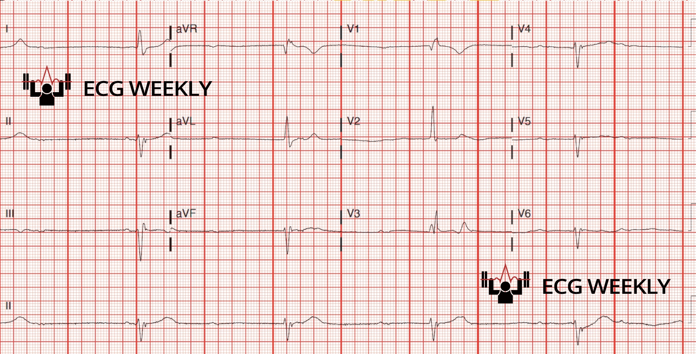 Presenting ECG — Key Points to Note About Complete Heart Block