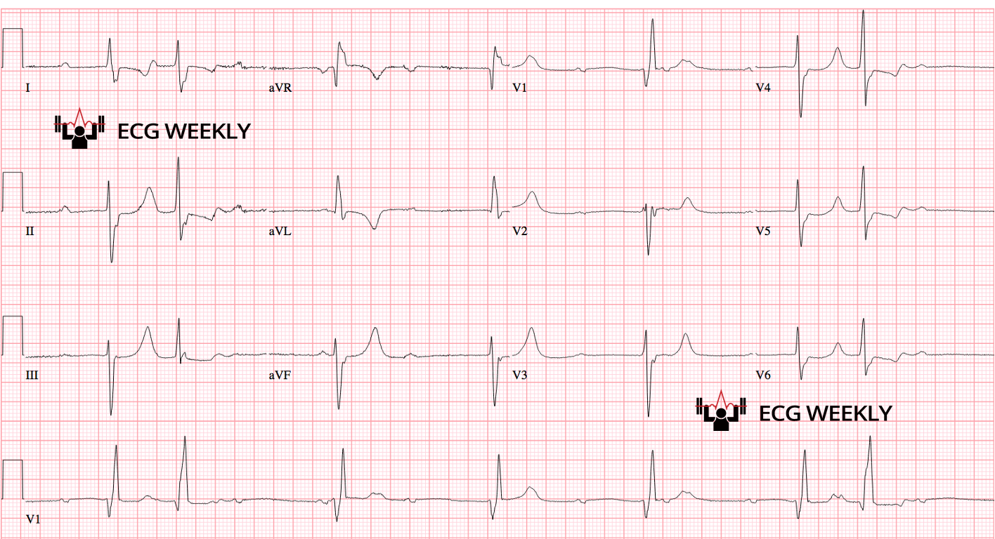 Presenting ECG — Distinction Between AV Dissociation and Complete Heart Block
