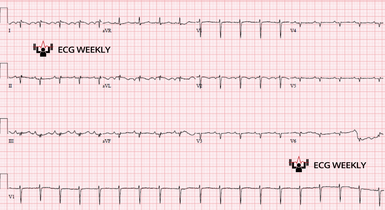 Presenting ECG — Navigating a Very Abnormal QRS Axis with a Stepwise Approach