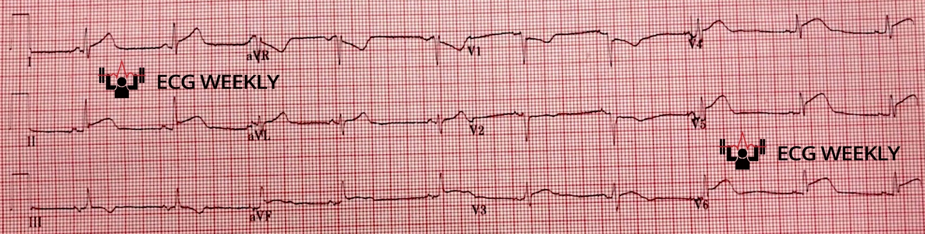 Presenting ECG — Cardiovascular Effects of Cannabis Use