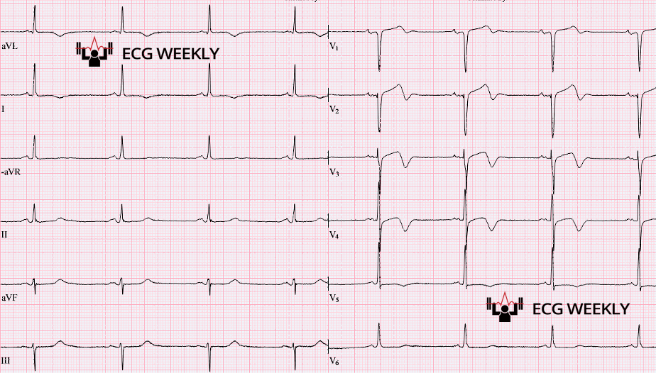 Presenting ECG — Biphasic T Waves in Suspected Acute Coronary Syndrome