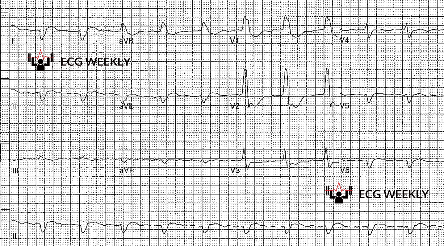 Presenting ECG — A Key Question That Clinches the Diagnosis