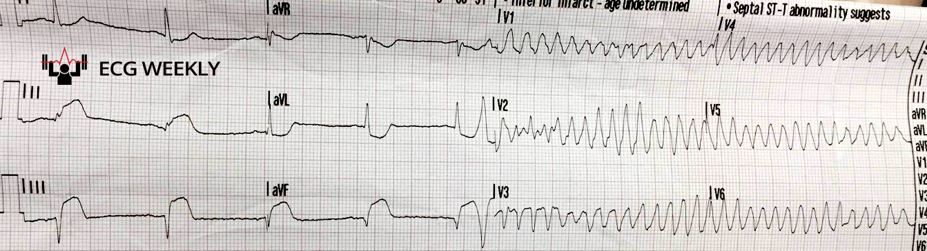 Presenting ECG — Case Potpourri: Avoiding AFib Misdiagnosis, Recognizing Mobitz, and Managing Polymorphic V-Tach