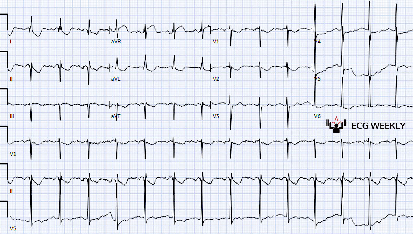 Presenting ECG — The Approach to Uncovering Hidden STEMI