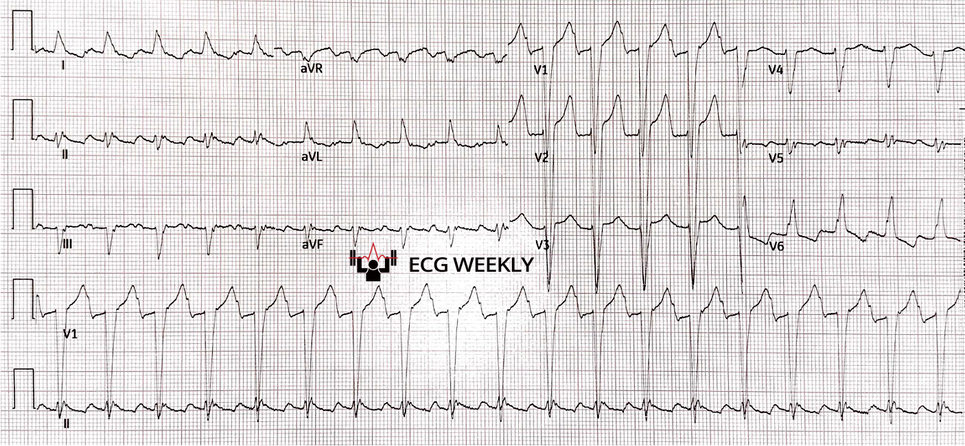 Presenting ECG — How the Lewis Lead Can Improve Tachyarrhythmia Diagnosis