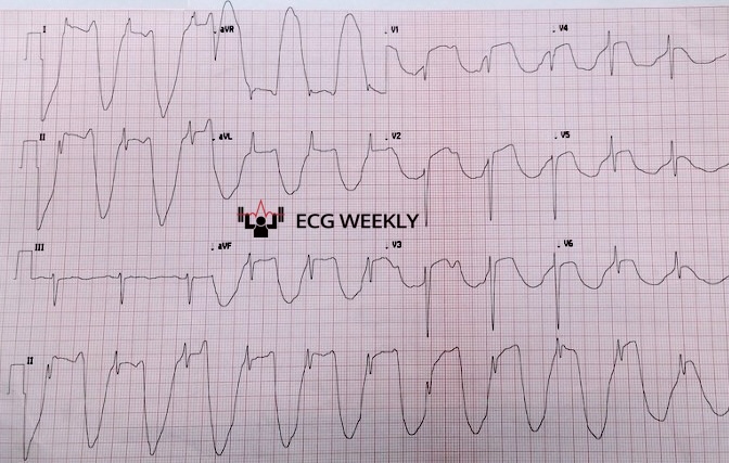 Presenting ECG — When One Lead Stands Alone: Deciphering Bizarre ECG Abnormalities