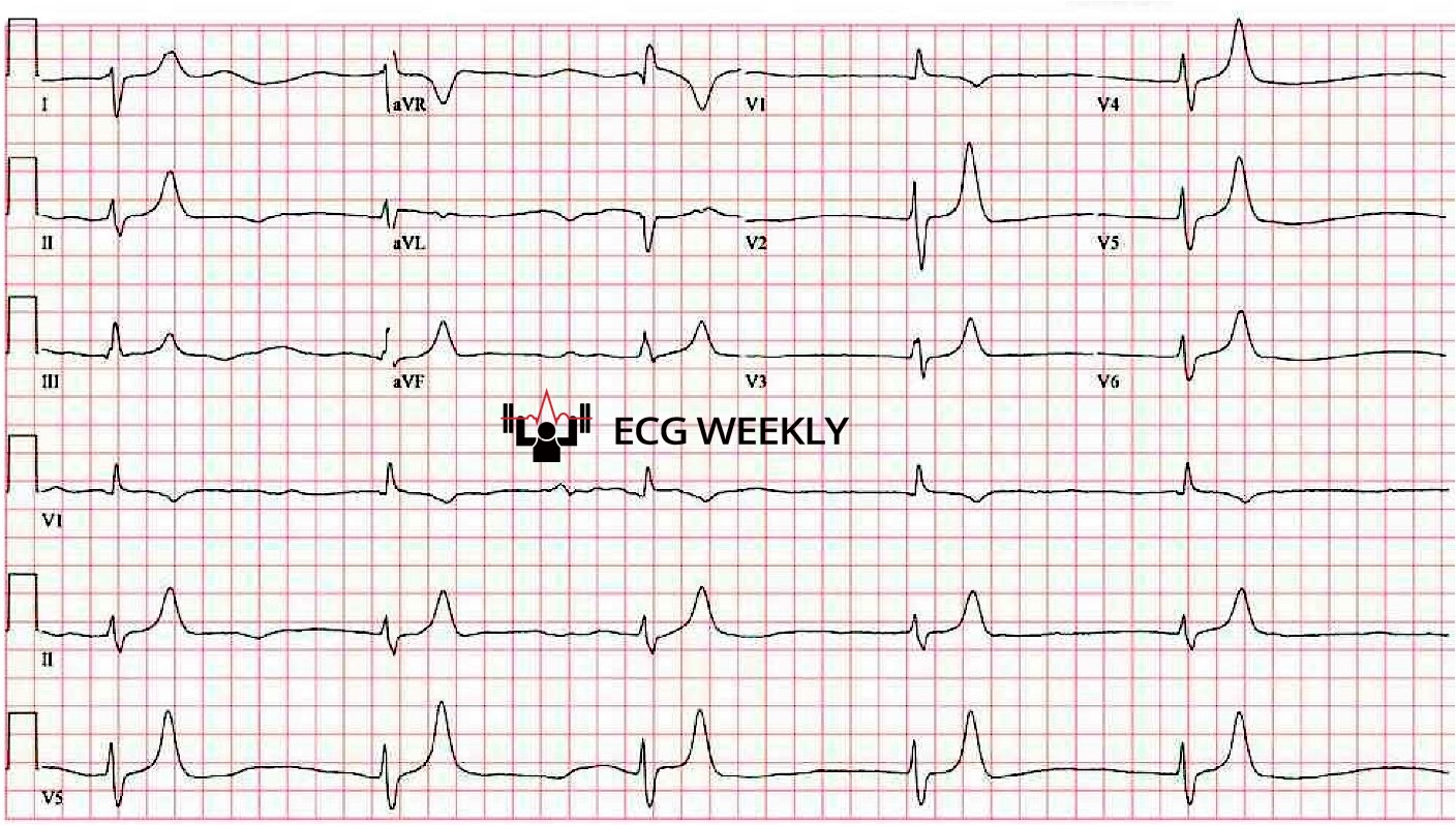 Presenting ECG — Paralysis Unmasked: ECG Clues That Saved the Day