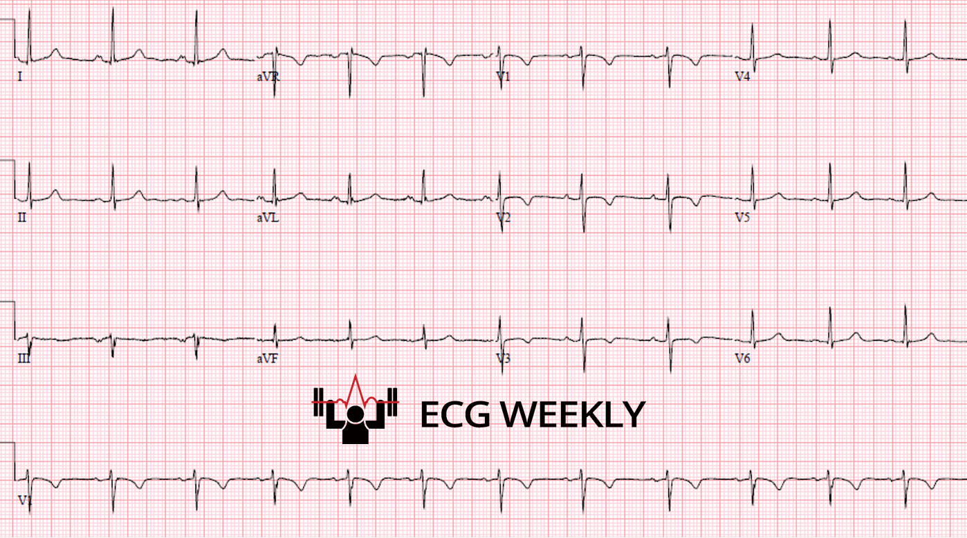 Presenting ECG — Anterior T Wave Inversions: Benign Variant or Hidden Danger?