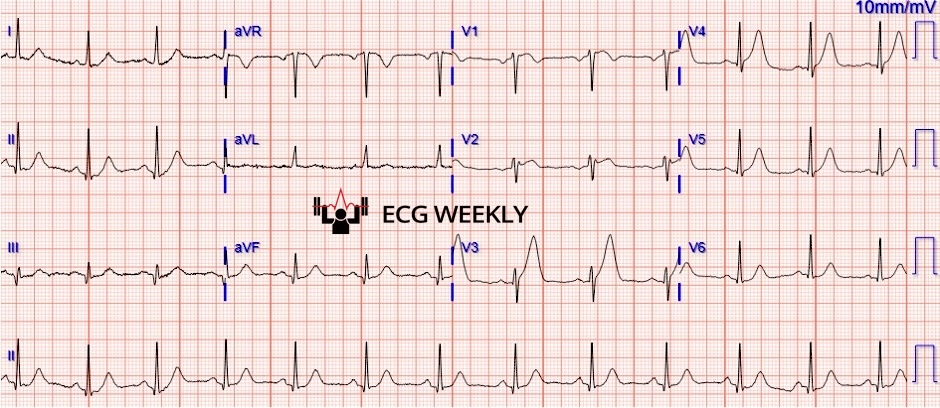 Presenting ECG — Respect the T Wave: Early Clues to Cardiac Ischemia