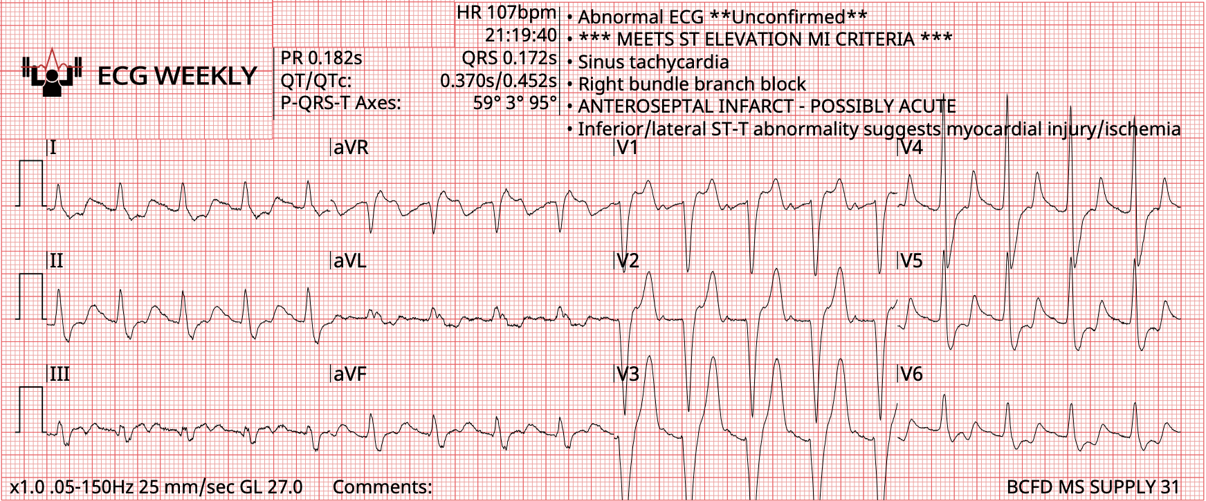 Presenting ECG — 2025 EMS Cases Part II
