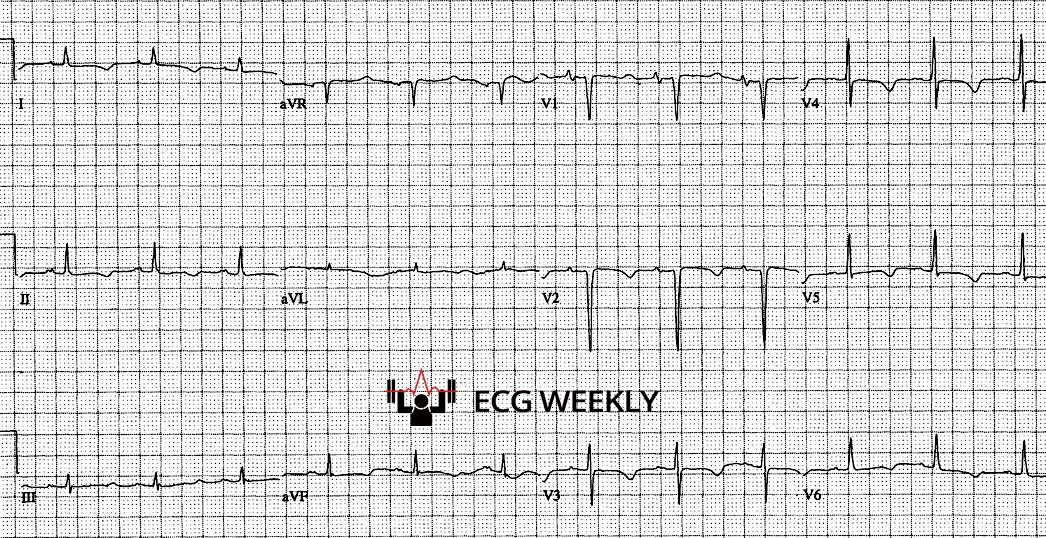 Presenting ECG — Unrecognized Killers in Emergency Electrocardiography, Part II