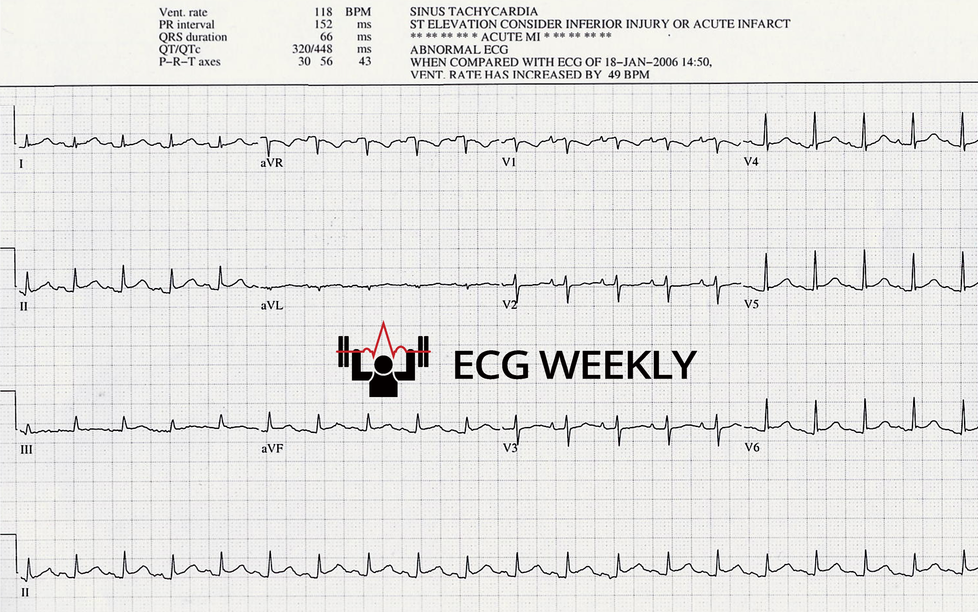 Presenting ECG — Unrecognized Killers in Emergency Electrocardiography, Part III