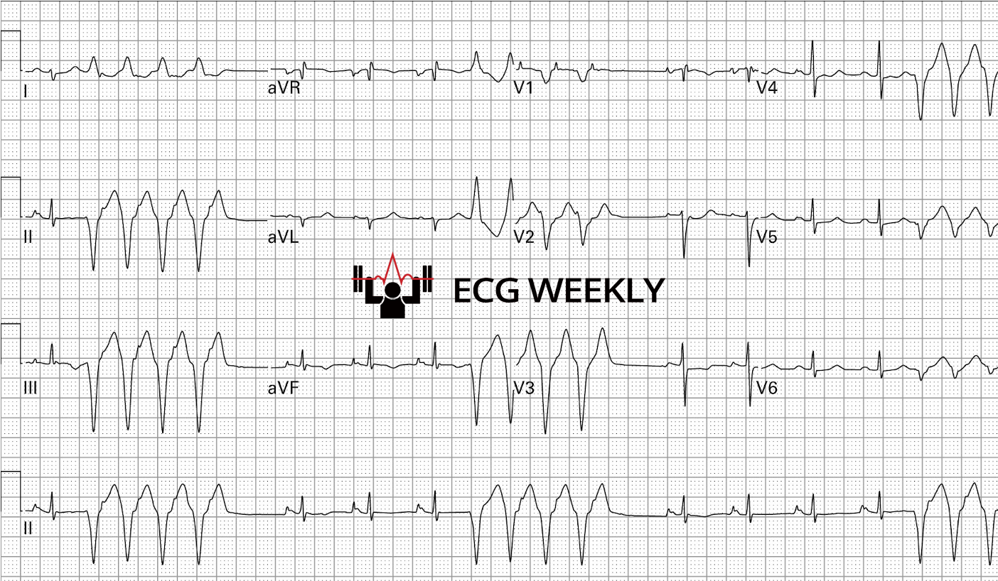 Presenting ECG — Optical Illusions and 12-Lead ECGs: How First Impressions Can Mislead