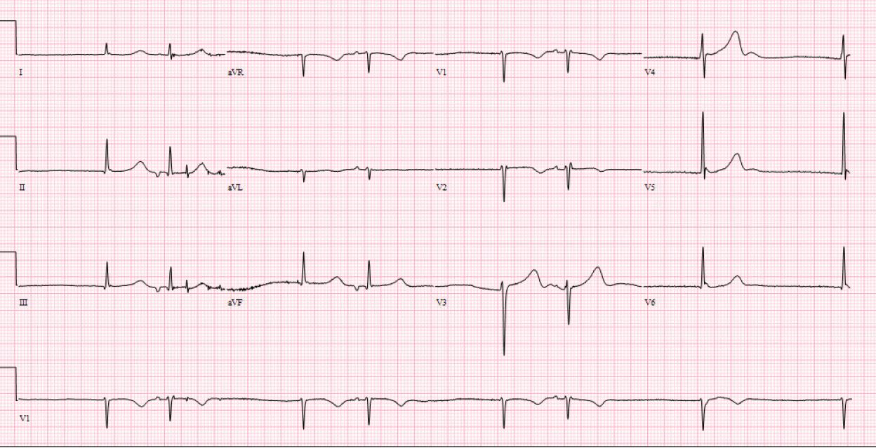 ECG10