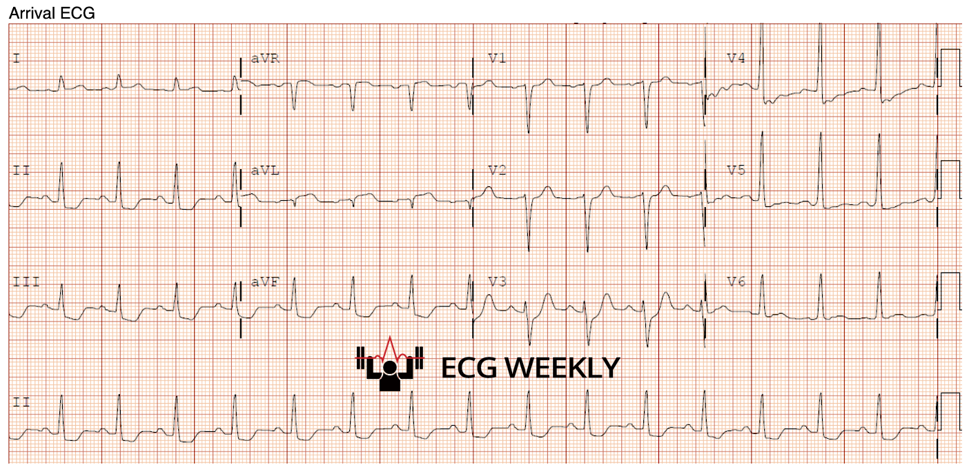 Presenting ECG — Beyond ST Elevation: Guideline Based Cath Lab Activation