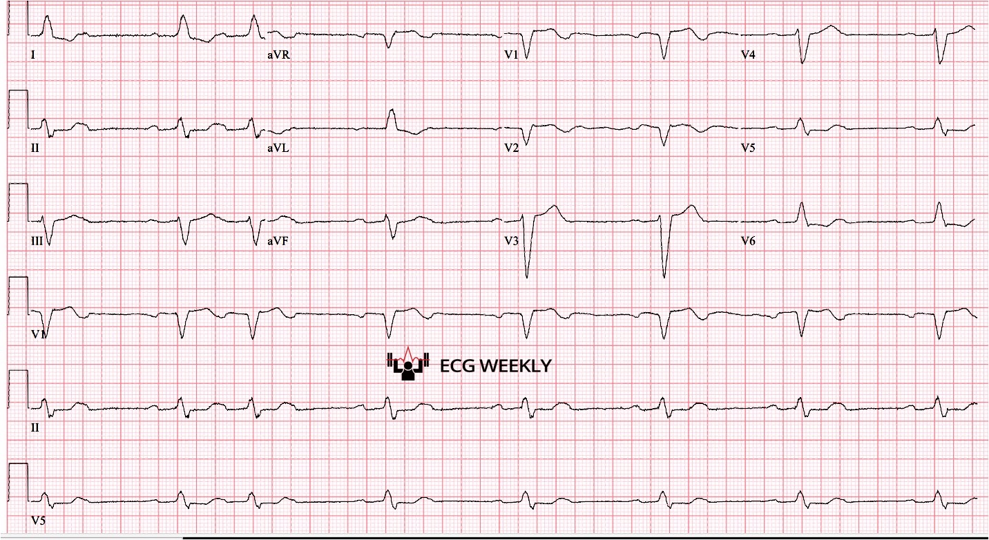 Presenting ECG — Mobitz I or Mobitz II: How to tell the difference