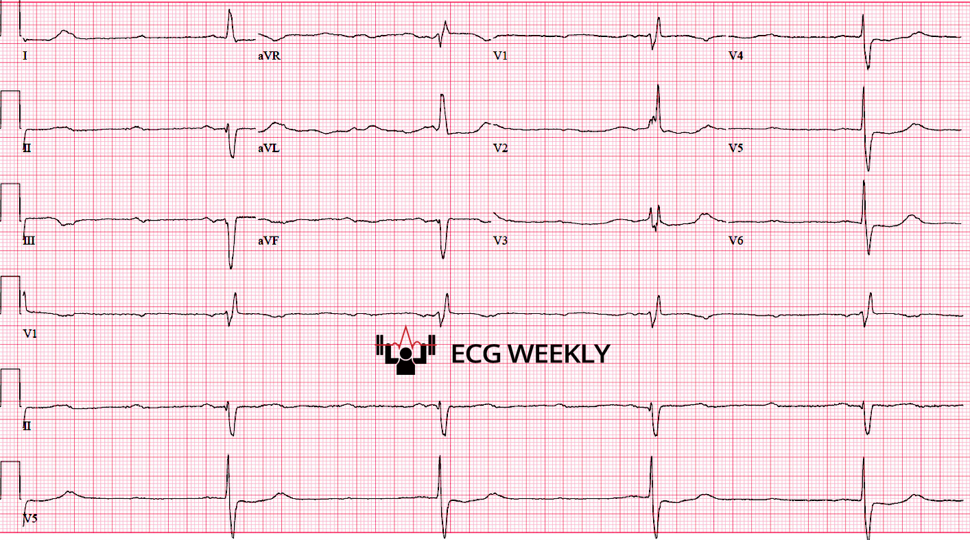 Presenting ECG — High-Grade AV Block: New Perspectives and Important Clarifications
