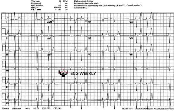 Presenting ECG — Regularly Irregular Rhythms: Sorting Mobitz from PACs and Other Causes