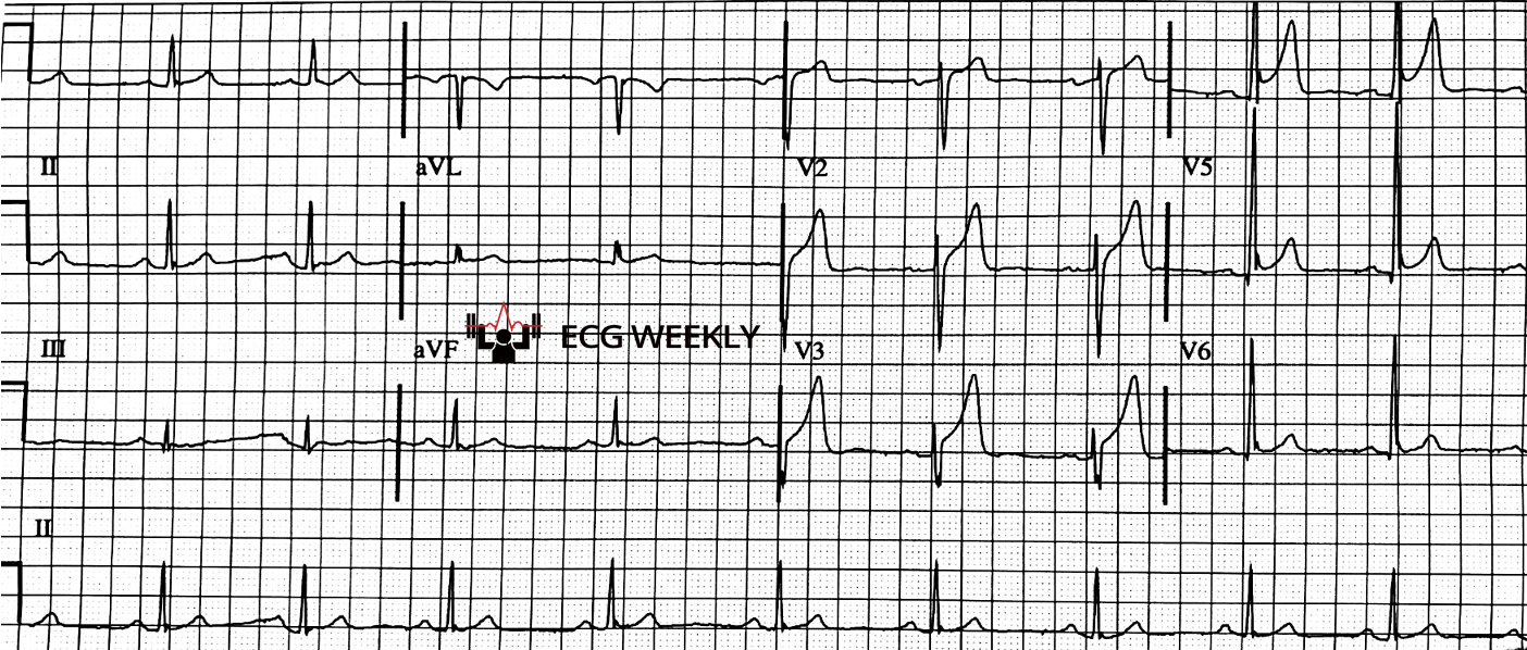 Presenting ECG — STEMI Diagnosis: Beyond the Millimeters