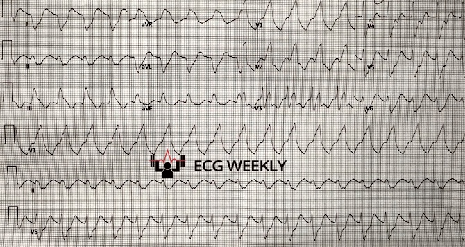 Presenting ECG — Really Wide, Kind of Slow: VT vs. Toxicity