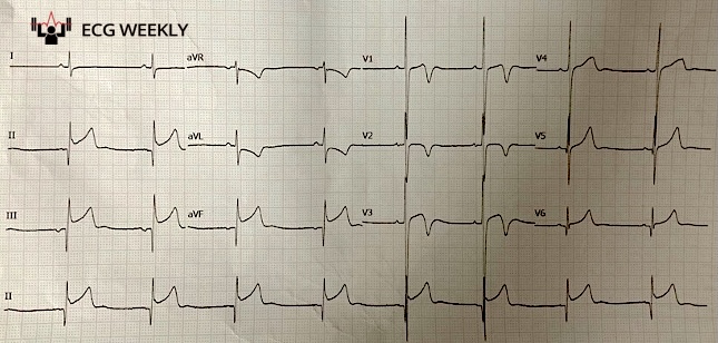 Presenting ECG — Not Your Usual STEMI: High Voltage and Narrow Q Waves