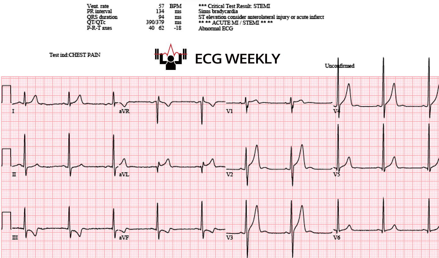 Presenting ECG — Cannabis Use and Premature Atherosclerosis: An ED Risk Factor To Ask About?