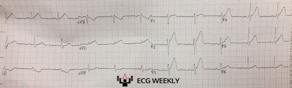 Presenting ECG — STEMI in a Postpartum Woman: A Case Against Risk Factor Bias