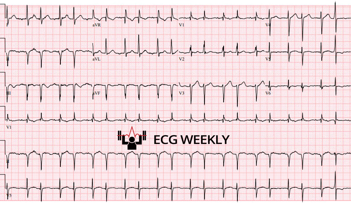 Presenting ECG — AFib Overdiagnosis: Dangerous Pitfalls and Safer Reads