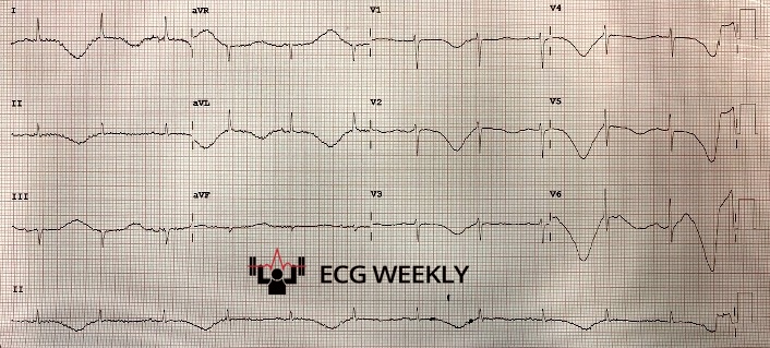 Presenting ECG — Not Cerebral T Waves: The Beat-to-Beat Warning You Cannot Miss