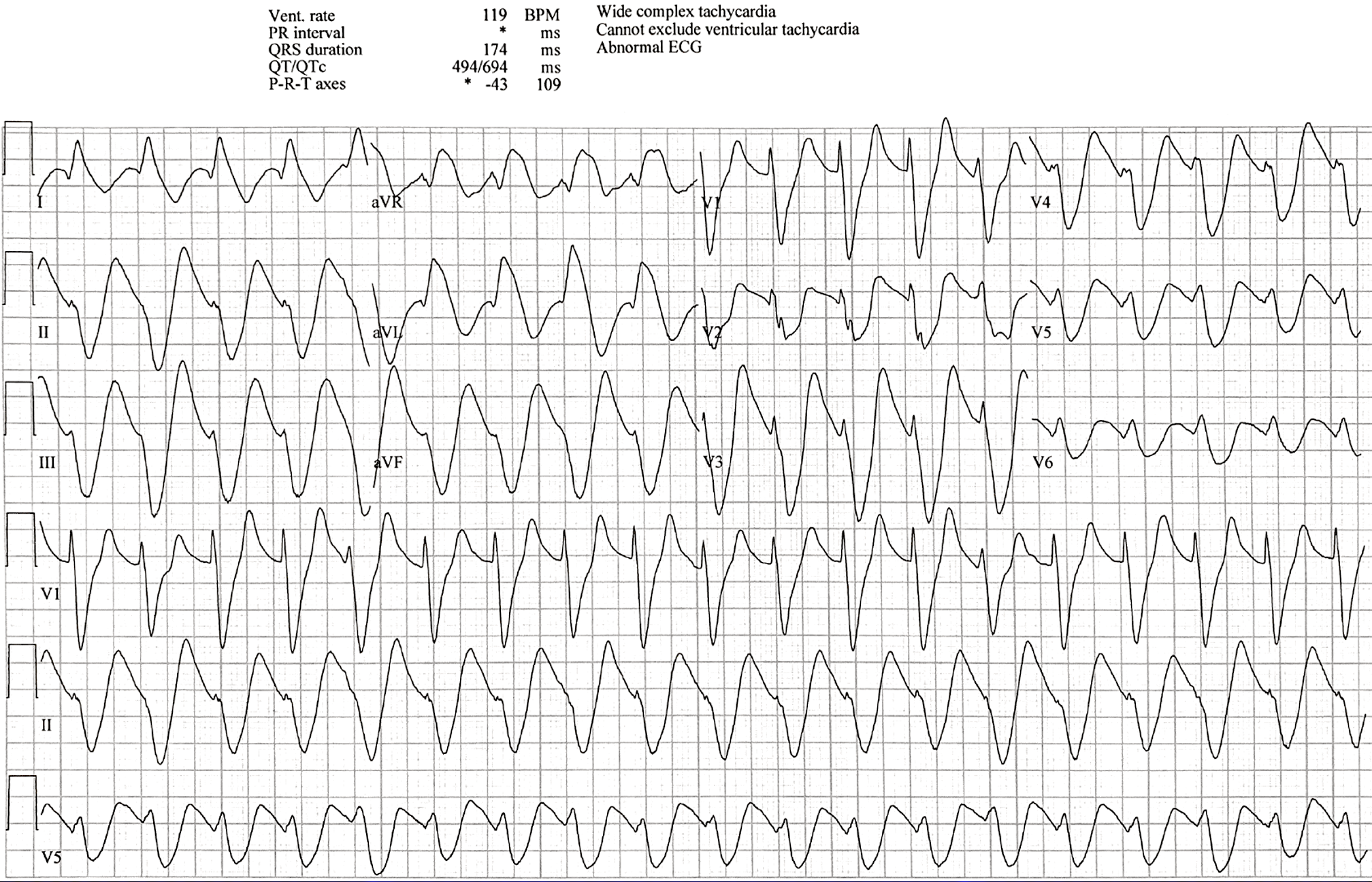 Presenting ECG — The Post-Thanksgiving Rhythm You Cannot Miss