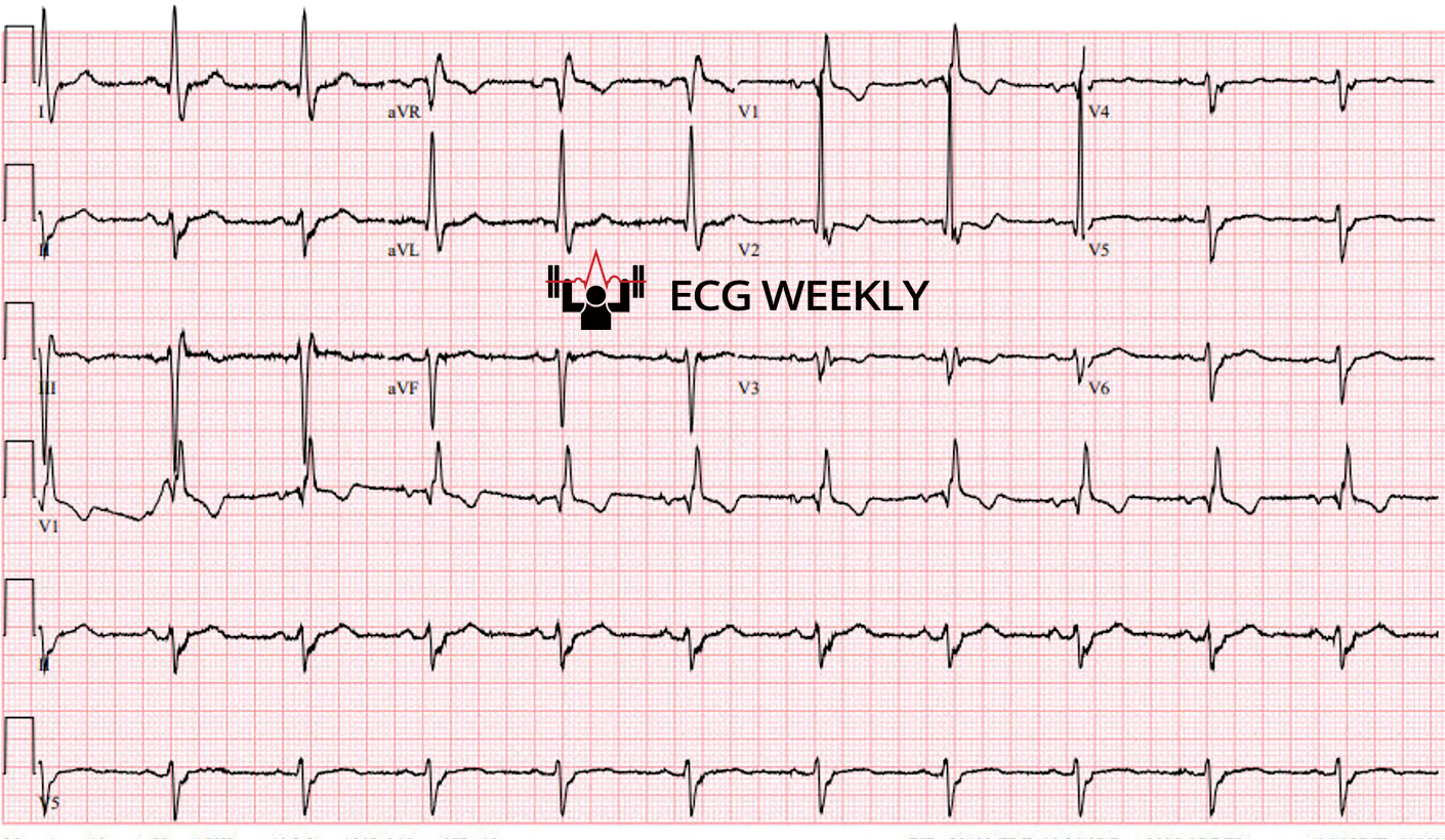 Presenting ECG — In the Era of High-Sensitivity Troponin, Does Unstable Angina Still Exist?
